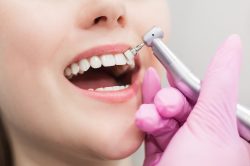 Blanqueamiento dental